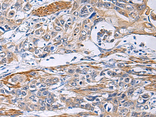 Immunohistochemistry of paraffin-embedded Human esophagus cancer tissue  using FBXO45 Polyclonal Antibody at dilution of 1:40(×200)