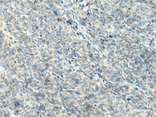Immunohistochemistry of paraffin-embedded Human ovarian cancer tissue  using NPVF Polyclonal Antibody at dilution of 1:80(×200)