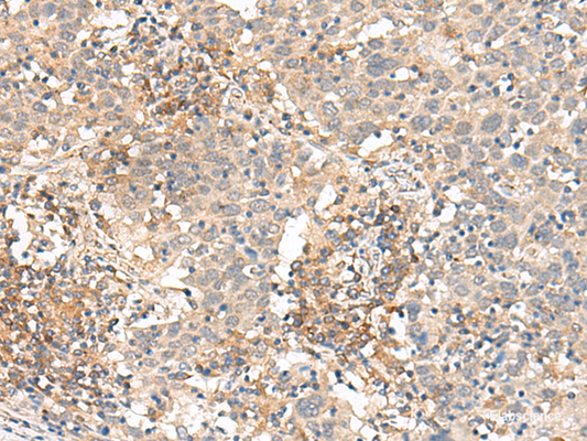 Immunohistochemistry of paraffin-embedded Human cervical cancer tissue  using SLC40A1 Polyclonal Antibody at dilution of 1:90(×200)
