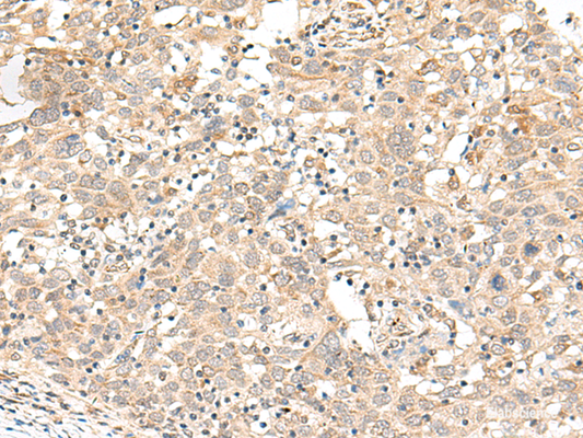 Immunohistochemistry of paraffin-embedded Human cervical cancer tissue  using FUT3 Polyclonal Antibody at dilution of 1:35(×200)