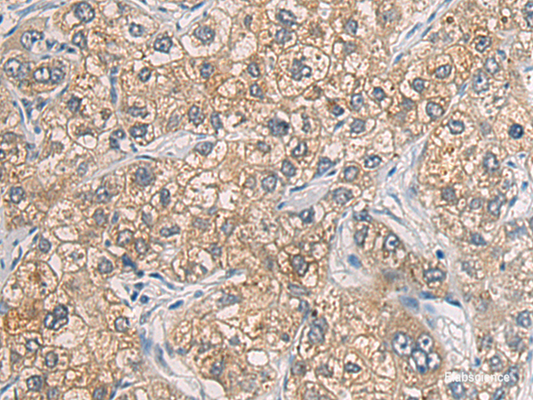 Immunohistochemistry of paraffin-embedded Human liver cancer tissue  using GAB4 Polyclonal Antibody at dilution of 1:60(×200)