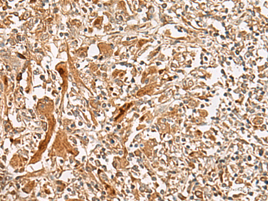 Immunohistochemistry of paraffin-embedded Human liver cancer tissue  using GCC2 Polyclonal Antibody at dilution of 1:45(×200)