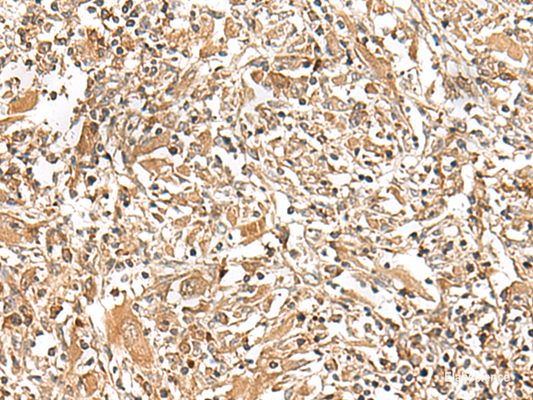 Immunohistochemistry of paraffin-embedded Human liver cancer tissue  using GEMIN4 Polyclonal Antibody at dilution of 1:30(×200)