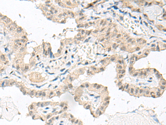 Immunohistochemistry of paraffin-embedded Human thyroid cancer tissue  using GFI1B Polyclonal Antibody at dilution of 1:80(×200)