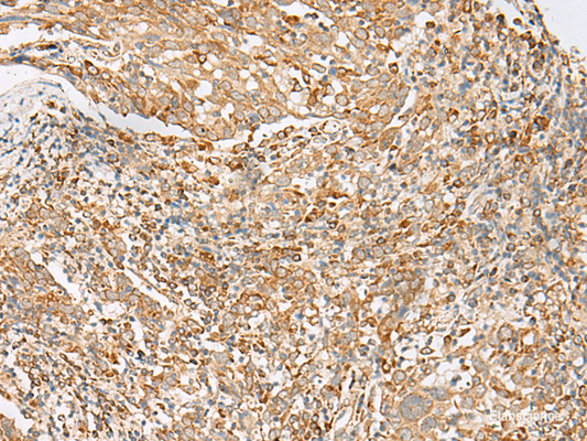 Immunohistochemistry of paraffin-embedded Human cervical cancer tissue  using MBOAT4 Polyclonal Antibody at dilution of 1:30(×200)