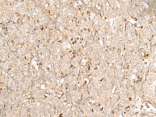 Immunohistochemistry of paraffin-embedded Human ovarian cancer tissue  using NUP210 Polyclonal Antibody at dilution of 1:30(×200)