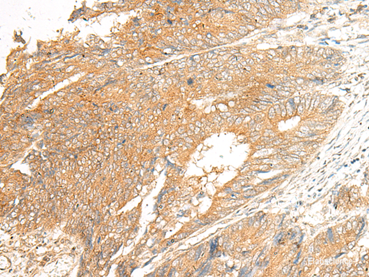 Immunohistochemistry of paraffin-embedded Human colorectal cancer tissue  using C5AR2 Polyclonal Antibody at dilution of 1:25(×200)