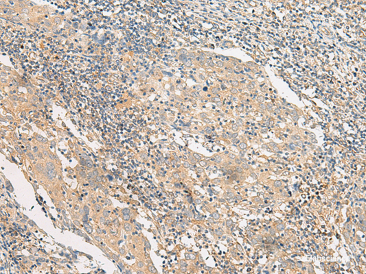 Immunohistochemistry of paraffin-embedded Human cervical cancer tissue  using POLR2L Polyclonal Antibody at dilution of 1:45(×200)