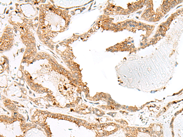 Immunohistochemistry of paraffin-embedded Human thyroid cancer tissue  using ENAH Polyclonal Antibody at dilution of 1:60(×200)