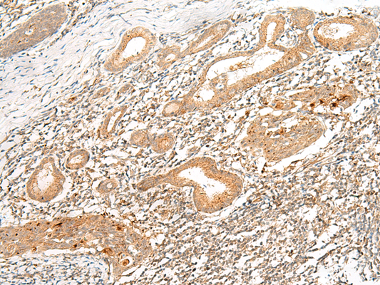 Immunohistochemistry of paraffin-embedded Human esophagus cancer tissue  using HLA-G Polyclonal Antibody at dilution of 1:45(×200)