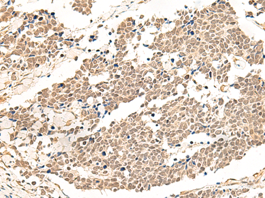 Immunohistochemistry of paraffin-embedded Human lung cancer tissue  using GPR139 Polyclonal Antibody at dilution of 1:50(×200)