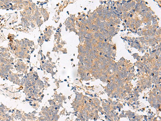 Immunohistochemistry of paraffin-embedded Human lung cancer tissue  using GPR153 Polyclonal Antibody at dilution of 1:40(×200)