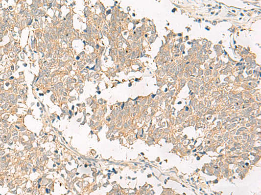 Immunohistochemistry of paraffin-embedded Human lung cancer tissue  using GPR161 Polyclonal Antibody at dilution of 1:40(×200)