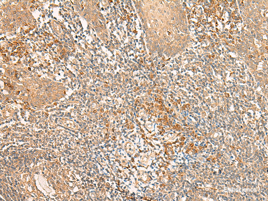 Immunohistochemistry of paraffin-embedded Human tonsil tissue  using WLS Polyclonal Antibody at dilution of 1:50(×200)