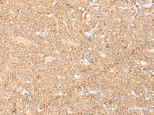 Immunohistochemistry of paraffin-embedded Human ovarian cancer tissue  using LGALSL Polyclonal Antibody at dilution of 1:70(×200)