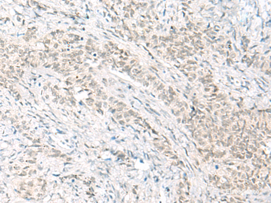 Immunohistochemistry of paraffin-embedded Human ovarian cancer tissue  using HABP4 Polyclonal Antibody at dilution of 1:60(×200)