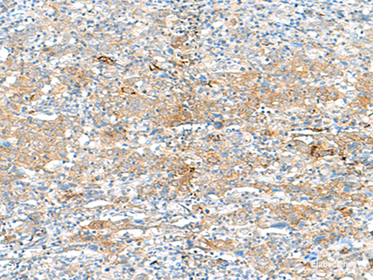 Immunohistochemistry of paraffin-embedded Human cervical cancer tissue  using HLA-DRB3 Polyclonal Antibody at dilution of 1:50(×200)