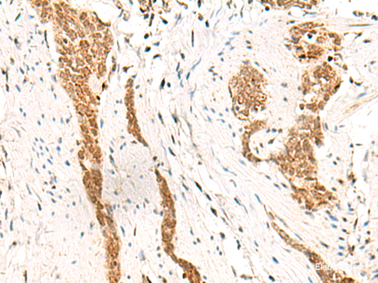 Immunohistochemistry of paraffin-embedded Human esophagus cancer tissue  using HOXC13 Polyclonal Antibody at dilution of 1:60(×200)