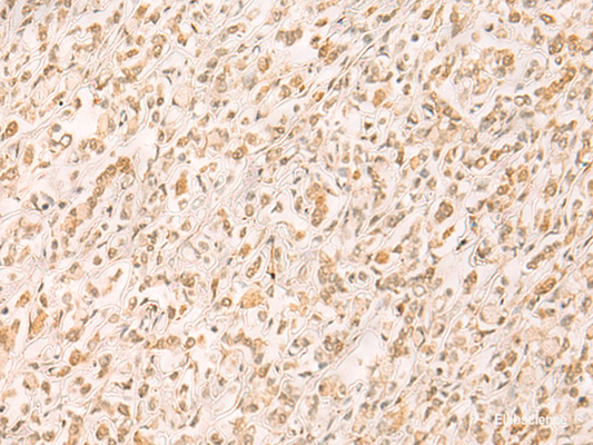 Immunohistochemistry of paraffin-embedded Human gastric cancer tissue  using SETD1A Polyclonal Antibody at dilution of 1:25(×200)