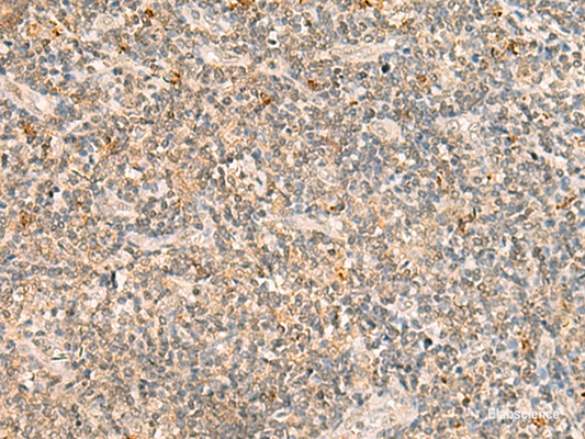 Immunohistochemistry of paraffin-embedded Human tonsil tissue  using TBCK Polyclonal Antibody at dilution of 1:25(×200)