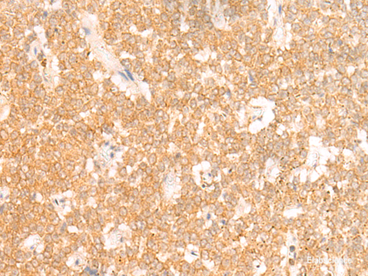 Immunohistochemistry of paraffin-embedded Human ovarian cancer tissue  using RRP8 Polyclonal Antibody at dilution of 1:50(×200)