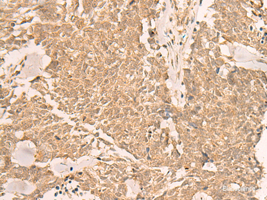Immunohistochemistry of paraffin-embedded Human lung cancer tissue  using IL1RAPL2 Polyclonal Antibody at dilution of 1:25(×200)