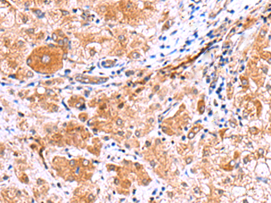 Immunohistochemistry of paraffin-embedded Human liver cancer tissue  using IRGC Polyclonal Antibody at dilution of 1:30(×200)
