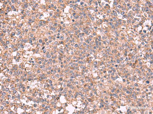 Immunohistochemistry of paraffin-embedded Human tonsil tissue  using MAPK8IP3 Polyclonal Antibody at dilution of 1:45(×200)