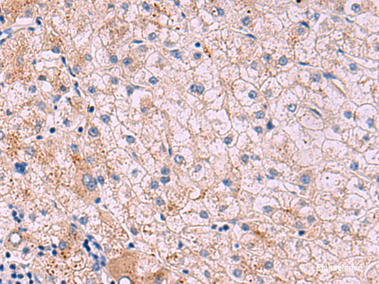 Immunohistochemistry of paraffin-embedded Human liver cancer tissue  using JAM3 Polyclonal Antibody at dilution of 1:40(×200)