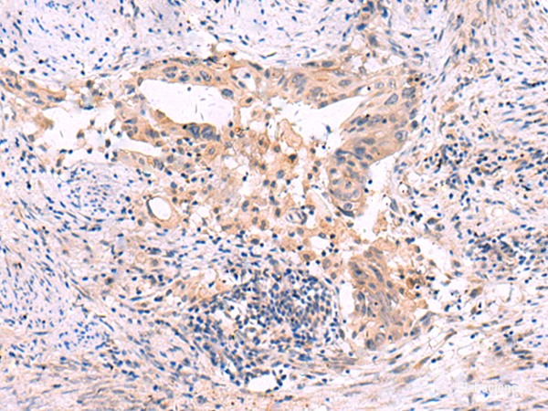 Immunohistochemistry of paraffin-embedded Human cervical cancer tissue  using SLC12A5 Polyclonal Antibody at dilution of 1:40(×200)