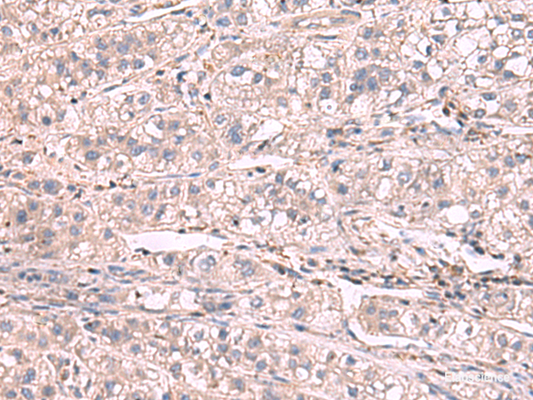Immunohistochemistry of paraffin-embedded Human liver cancer tissue  using KCNIP1 Polyclonal Antibody at dilution of 1:60(×200)