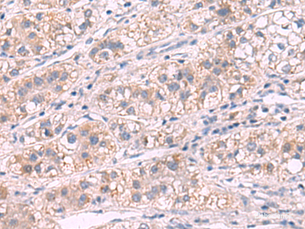 Immunohistochemistry of paraffin-embedded Human liver cancer tissue  using G6PC Polyclonal Antibody at dilution of 1:50(×200)