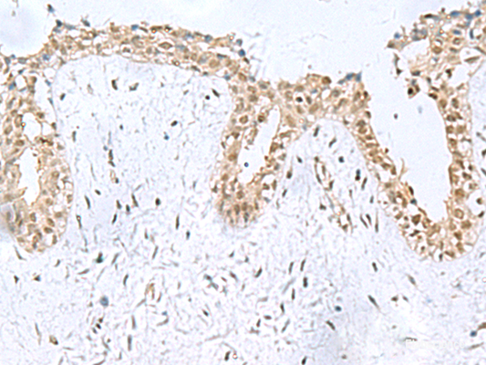 Immunohistochemistry of paraffin-embedded Human breast cancer tissue  using KDM2B Polyclonal Antibody at dilution of 1:50(×200)