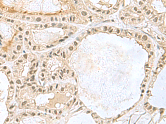 Immunohistochemistry of paraffin-embedded Human thyroid cancer tissue  using KDM3B Polyclonal Antibody at dilution of 1:45(×200)