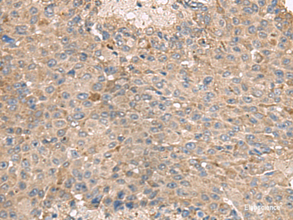 Immunohistochemistry of paraffin-embedded Human liver cancer tissue  using ABCA10 Polyclonal Antibody at dilution of 1:50(×200)