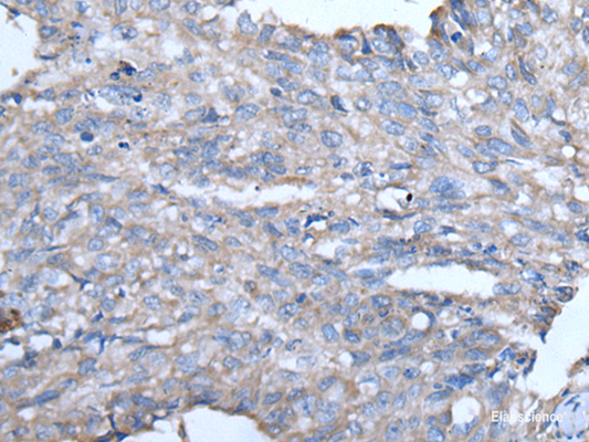 Immunohistochemistry of paraffin-embedded Human lung cancer tissue  using GJA1 Polyclonal Antibody at dilution of 1:50(×200)