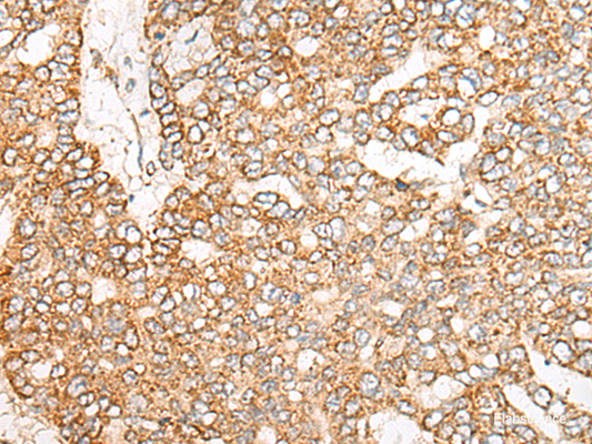 Immunohistochemistry of paraffin-embedded Human liver cancer tissue  using NME4 Polyclonal Antibody at dilution of 1:45(×200)