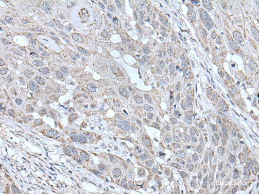 Immunohistochemistry of paraffin-embedded Human esophagus cancer tissue  using SCNN1G Polyclonal Antibody at dilution of 1:40(×200)