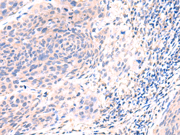 Immunohistochemistry of paraffin-embedded Human cervical cancer tissue  using ESM1 Polyclonal Antibody at dilution of 1:50(×200)