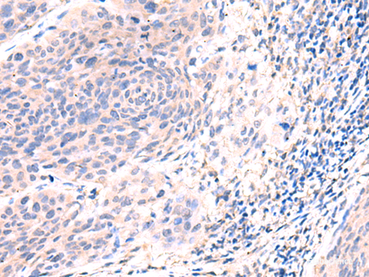 Immunohistochemistry of paraffin-embedded Human cervical cancer tissue  using ESM1 Polyclonal Antibody at dilution of 1:50(×200)