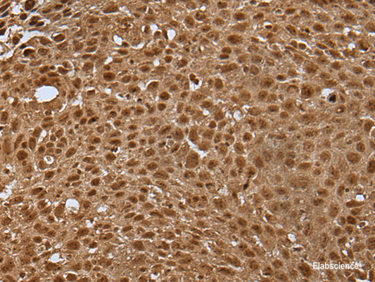Immunohistochemistry of paraffin-embedded Human lung cancer tissue  using LAMTOR5 Polyclonal Antibody at dilution of 1:35(×200)
