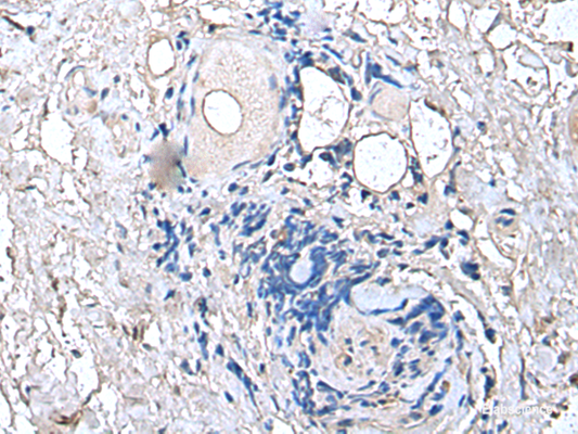 Immunohistochemistry of paraffin-embedded Human thyroid cancer tissue  using PTP4A1 Polyclonal Antibody at dilution of 1:45(×200)