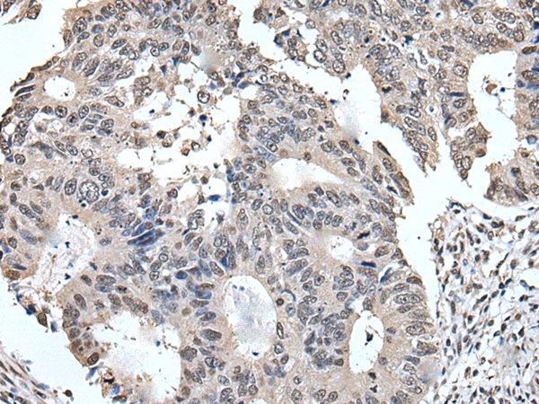 Immunohistochemistry of paraffin-embedded Human colorectal cancer tissue  using TRIM23 Polyclonal Antibody at dilution of 1:55(×200)