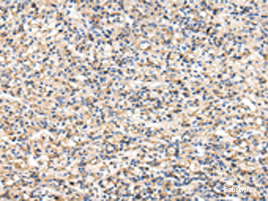 Immunohistochemistry of paraffin-embedded Human prost at e cancer tissue  using VCAM1 Polyclonal Antibody at dilution of 1:30(×200)