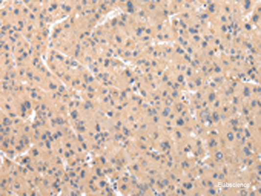 Immunohistochemistry of paraffin-embedded Human liver cancer tissue  using ZNF268 Polyclonal Antibody at dilution of 1:50(×200)