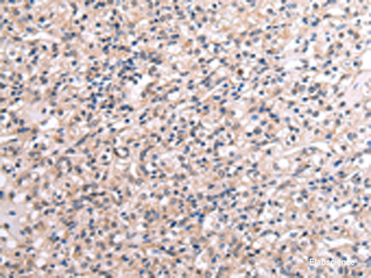Immunohistochemistry of paraffin-embedded Human liver cancer tissue  using RNF115 Polyclonal Antibody at dilution of 1:45(×200)