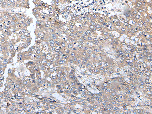 Immunohistochemistry of paraffin-embedded Human liver cancer tissue  using BRMS1L Polyclonal Antibody at dilution of 1:45(×200)