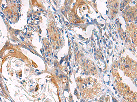Immunohistochemistry of paraffin-embedded Human esophagus cancer tissue  using LYPLA1 Polyclonal Antibody at dilution of 1:45(×200)