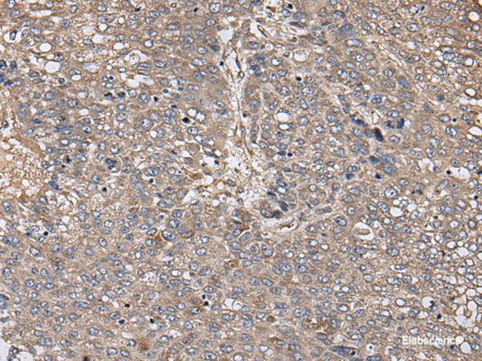 Immunohistochemistry of paraffin-embedded Human liver cancer tissue  using ZFP36 Polyclonal Antibody at dilution of 1:40(×200)