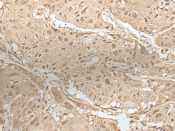 Immunohistochemistry of paraffin-embedded Human esophagus cancer tissue  using ZBTB18 Polyclonal Antibody at dilution of 1:50(×200)